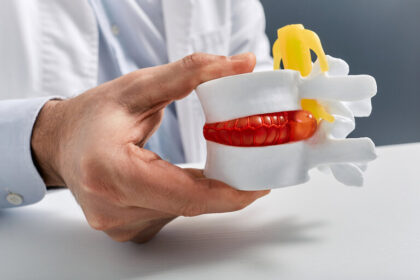 Anatomisches Modell eines lumbalen Bandscheibenvorfalls in der Hand eines Arztes während einer Konsultation in einer medizinischen Klinik. Behandlung einer Bandscheibenhernie